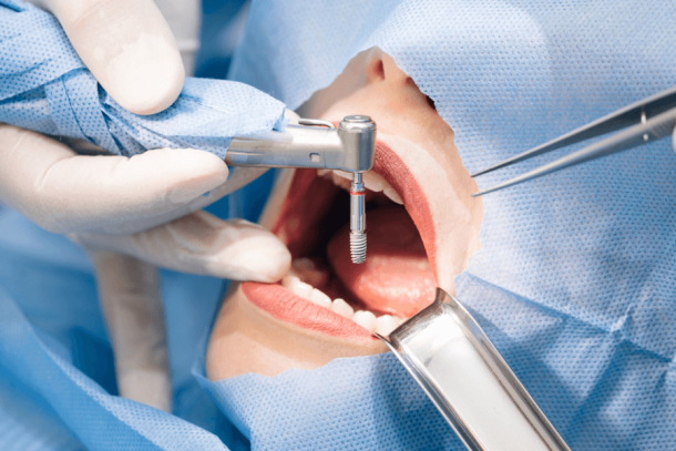 Simulação de cirurgia de remoçao de dente